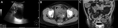 Sigmoido-vesical fistula secondary to sigmoid colon cancer presenting as urinary tract infection with Lactococcus lactis: A case report